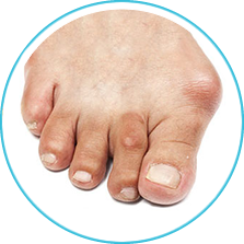 Bunions