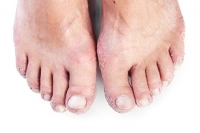 The Impact of Psoriatic Arthritis on the Feet and Ankles