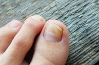 Toenail Fungus Is Contagious, and May Be Prevented